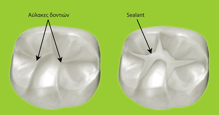 Sealants